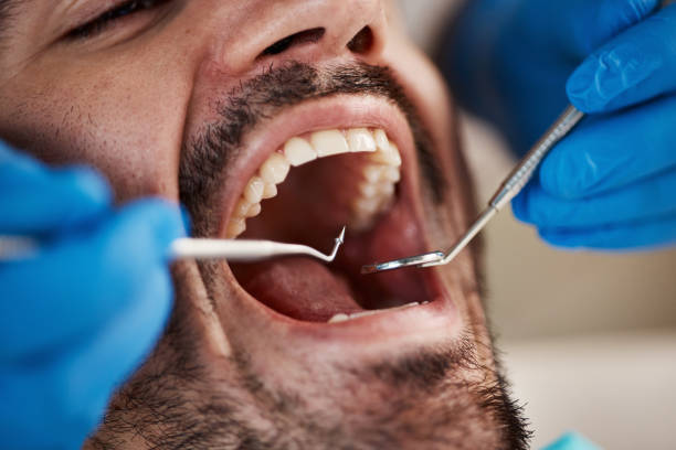 Best Emergency Tooth Extraction in Dutch Island, GA